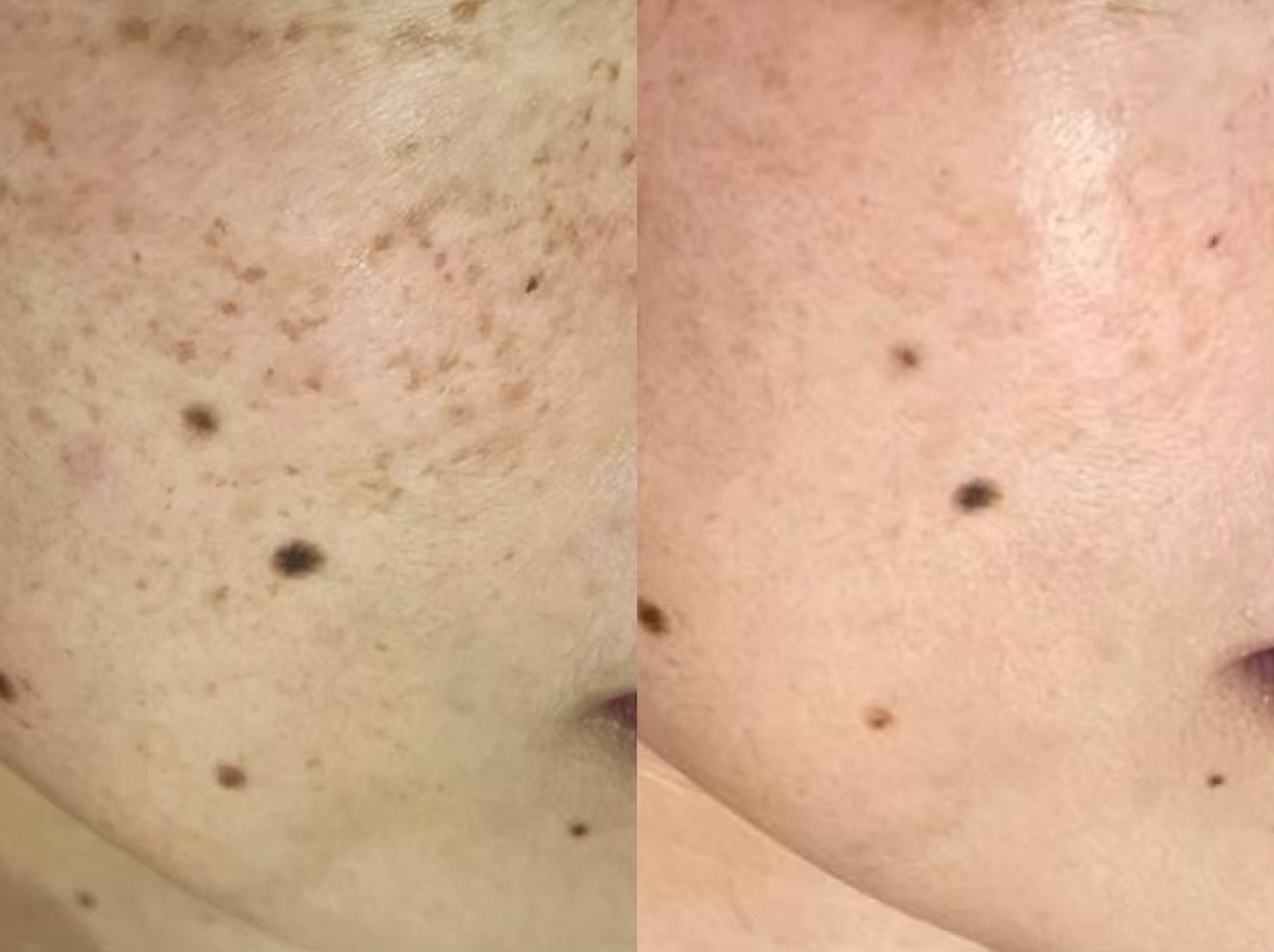 SAKURA施術のビフォーアフター