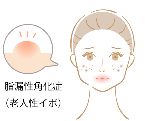 シミを放置すると…